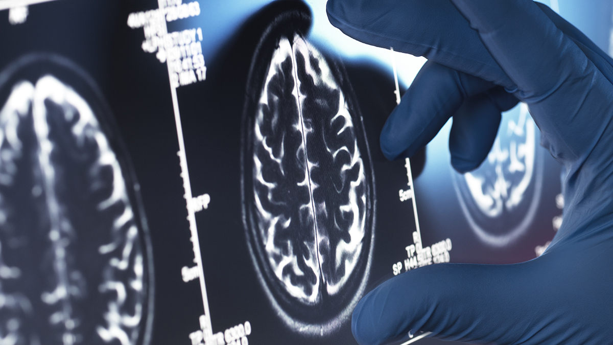 Much-Hyped Alzheimer's Drugs Show No Meaningful Benefit, Major Review Finds